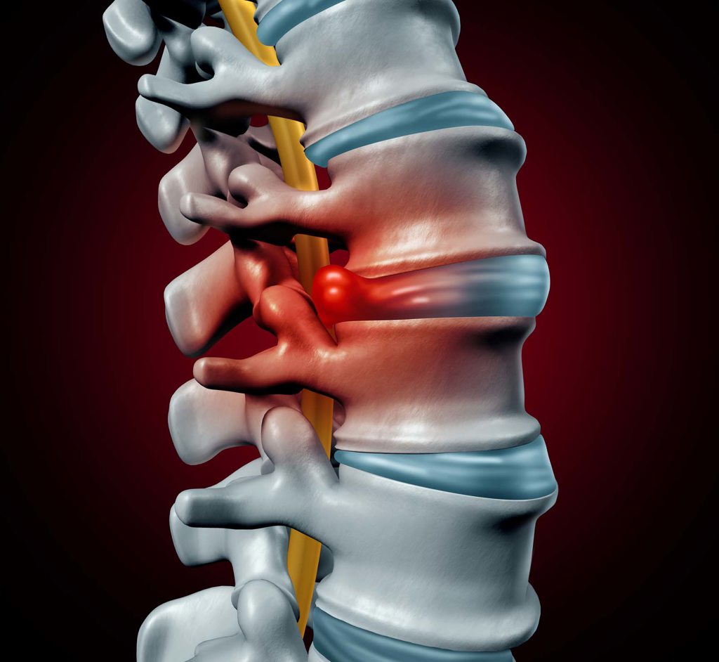 herniated disc